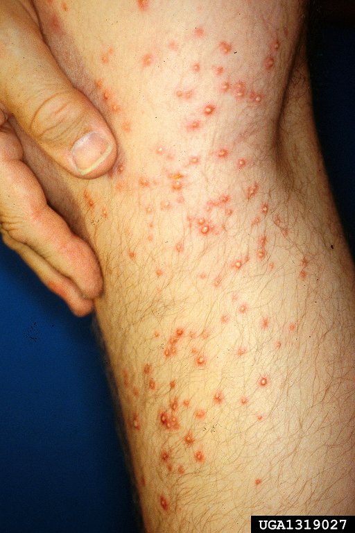 Fire Ant Bites - Daniel Wojcik, Bugwood.org